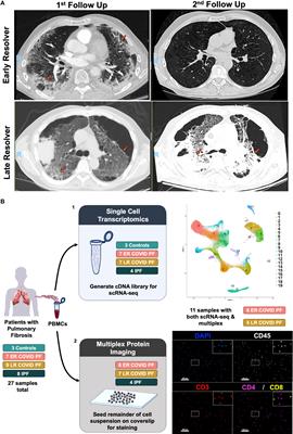 High-dimensional comparison of monocytes and T cells in post-COVID and idiopathic pulmonary fibrosis